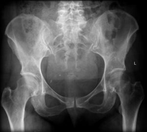 Femur Fracture from Motorcycle Accident in Idaho