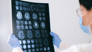 Nampa Brain Injury Attorney