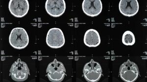 Pocatello Brain Injury Attorney