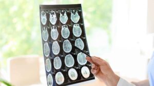 Post Falls Traumatic Brain Injury Attorney