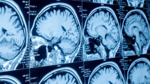 Rathdrum Traumatic Brain Injury Attorney